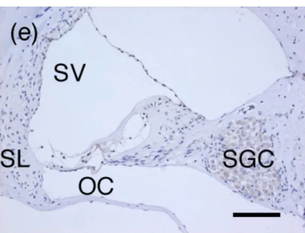 Figure 4: Immunohistochemical staining for CD74 expression in (a) middle ear cavity 