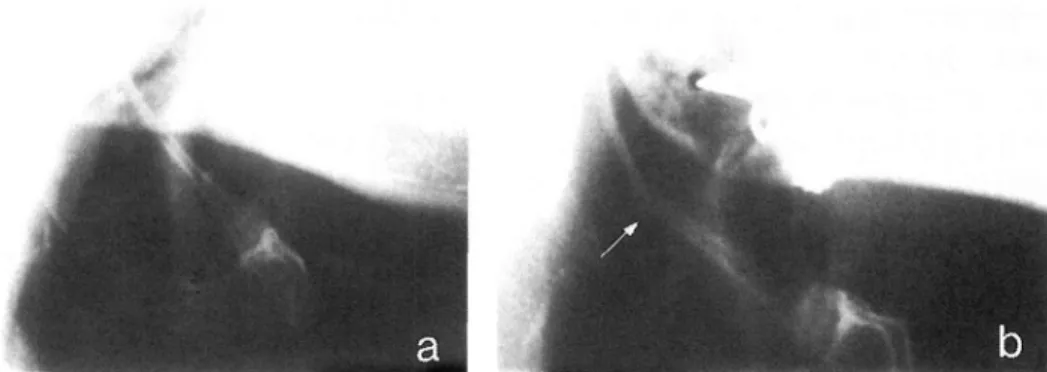 Figure  4  Lateral  jaw  radiograph  (Pre-operation,  a)  shows  no  abnormalities  except  the  fracture  in  the  body of  the  mandible  extending  from  the  third  molar