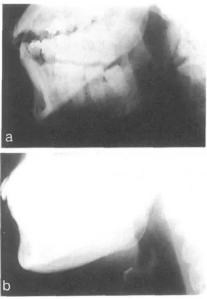 Figure  5  Oridinary  lateral  jaw  radiograph(a) shows  that  the  hyoid  bone  and  mandible  overlap  each other,  making  it  very  difficult  to  observe  the  hyoid bone