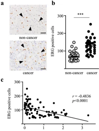 Figure 2.  ERG-positive endothelial cells in HCC tissues. (a) Representative images of ERG-positive cells in  a patient with moderately differentiated HCC