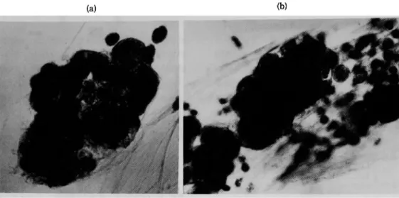Fig.  1a,  b  CrBの 形 態(パ パ ニ コロ ウ染 色,×400) 気 管 支 喘 息 患 者 喀痰 中 に認 め られ たCrBは,類 円 形 の 細 胞 集 塊 で全 体 に厚 み を持 ち,線 毛 の脱 落 し た気 管 支上 皮 細 胞 が辺 縁 に柵 状 配 列 し,腺 癌 細 胞 に 類 似 して い た(a).CrBの 周 辺 に は 好酸 球 も 多 く認 め られ た(b)