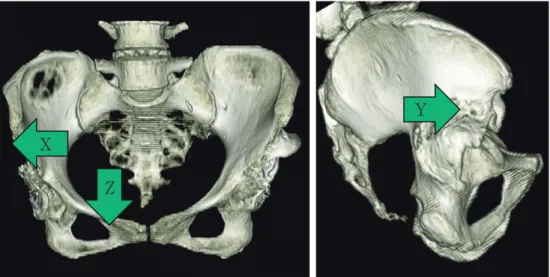 Fig. 2　 The anterior pelvic plane (APP) was used as a reference,  and the coordinates were deﬁned as follows: x-axis for the external  direction,  y-axis for the anterior direction,  and z-axis for the proximal direction