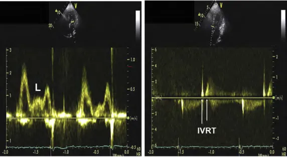 図 14 　心拍数 60 拍 / 分の HFpEF 患者における僧帽弁流入血流波形（左図）及び IVRT（右図）。E 速度は 96 cm/sec、A 速