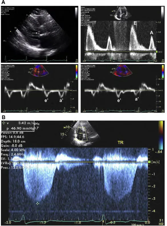 図 18 　（A）肥大型心筋症患者の傍胸骨長軸像の 2次元画像（左上）。僧帽弁の収縮期前方運動（矢印）を示す　。僧帽弁流入