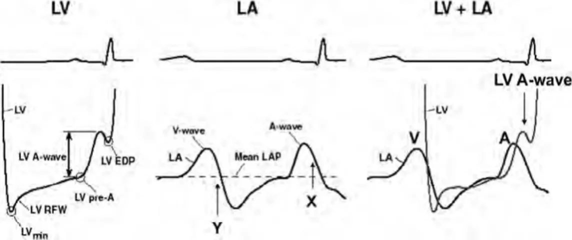 図 1 　（ 左 ）左室拡張期圧の記録。矢印は、左室最小圧（LV min）、左室急速充満波（LV RFW）、左室 pre-A 圧（LV pre-A）、