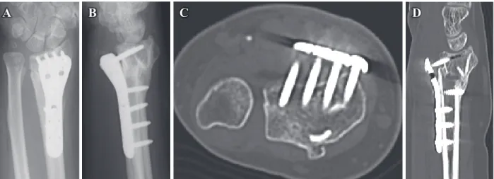 Fig. 14.  症例3の環指FDSを用いた腱 移行術の再手術術中写真．FDS: Flexor  Digitorium Superficialis.ABC D Fig. 12