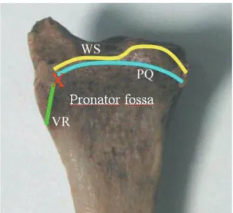 Fig. 15.  橈骨遠位端掌側部の骨性解剖．WS: Watershed 