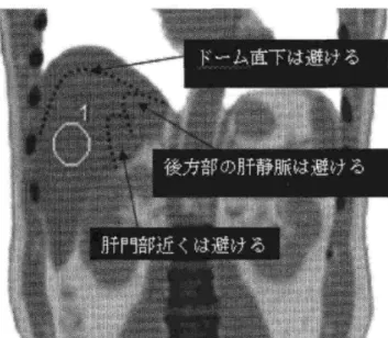 図 3.2.3.1.1  肝 SNR の解析における ROI の位置 