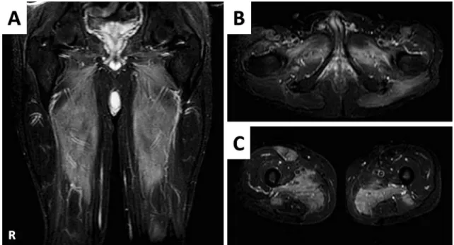 Fig. 2 Skeletal muscle images on fat-suppressed short T 1  inversion recovery MRI.