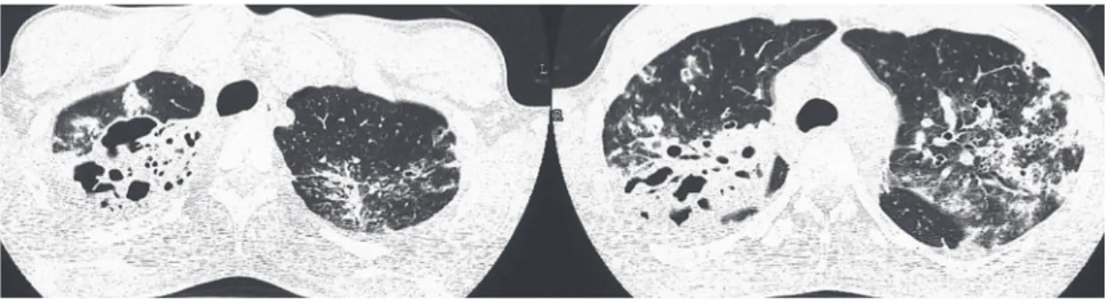 Fig. 6 CT  scan  from  the  same  case  showes  cavities,  segmental  consolidations,  centrilobular  nodules,  traction  bronchiectasis, ground-glass opacity.