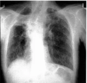 Fig.  1  Chest  X  ray  showed  fibrous  shadow  in bilateral  lung  and  right  side  shift  of  trachea.