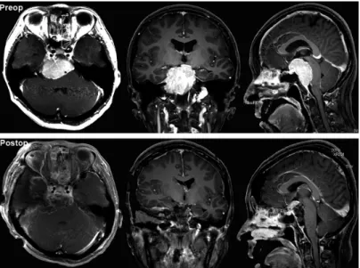 Fig. 2 Pre- and postoperative magnetic resonance images. The upper row shows preoperative images and the lower row shows postoperative images, respectively.