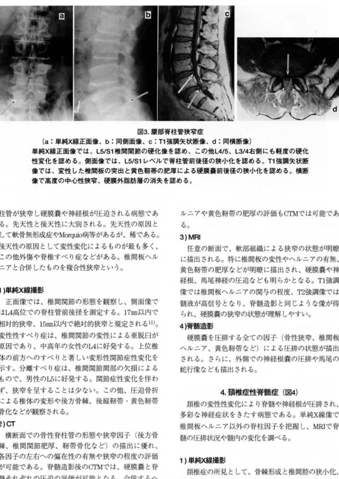 図 3. 腰部脊柱管狭窄症 (a: 単純X線正面像、 b: 同側面像、 c :  T1 強調矢状断像、 d: 同償断像) 単純X線正面像では、 L5/S1 椎間関節の硬化像を認め、この他 L4/5 、 L3/4右側にも軽度の硬化 性変化を認める 。 側面像では 、 L5/S1 レベルで脊柱管前後径の狭小化を認める 。 T1強調矢状断 像では、変性した椎間板の突出と貧色靭帯の肥厚による硬膜轟前後径の狭小化を認める 。 検断 像で高度の中心性狭窄、硬膜外脂肪層の消失を認める 。 柱管が狭窄し硬膜嚢や神経根が圧迫