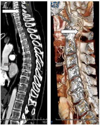 Fig. 2 CT angiography of spinal cord.
