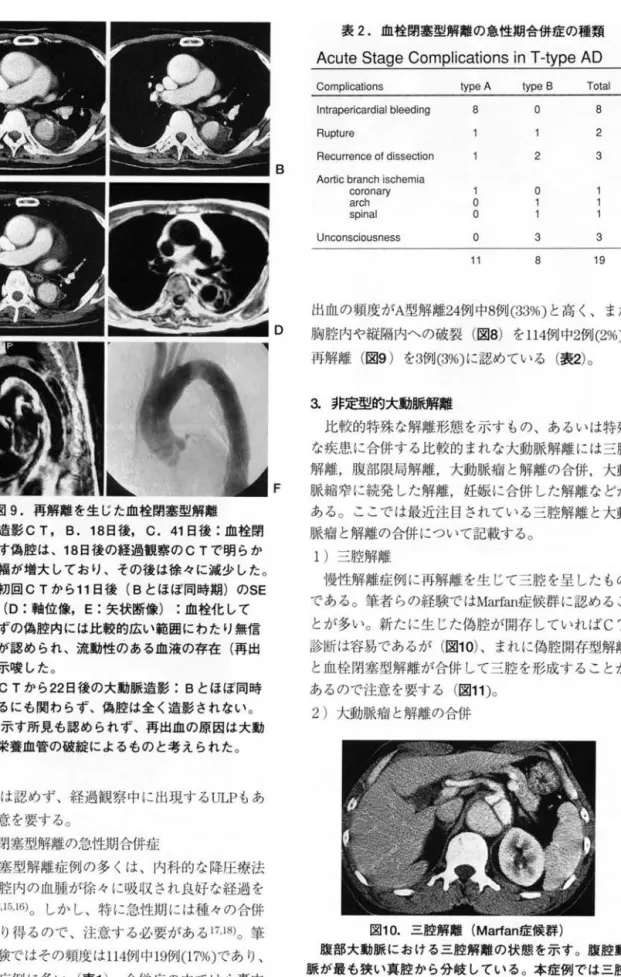 表 2. 血栓閉塞型解離の急性期合併症の種類