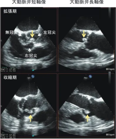 Fig. 66  大動脈弁に発生した疣贅（リアルタイム 3D エコー  X 