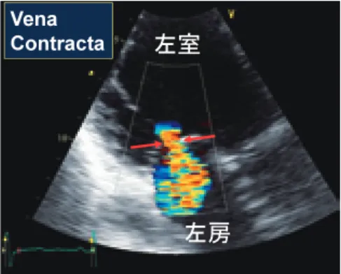 Fig. 11  三次元カラードプラ法による僧帽弁逸脱例逆流ジェットの Vena Contracta ．
