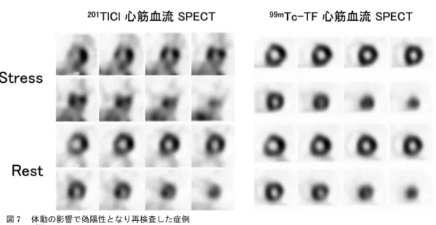 図 8 心筋 SPECT 画像の階調と表示スケール