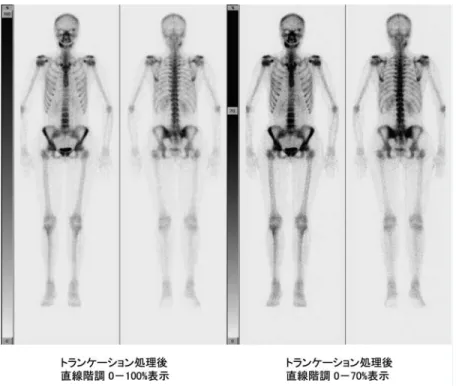 図 5 2 画像表示の 1 例 （トランケーション後直線階調表示と upper level 70％表示)