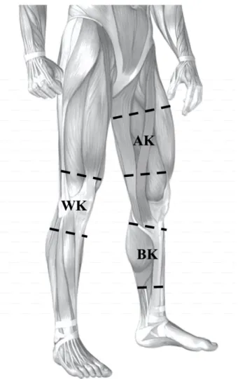 Fig. 4. Placement of CGs. The compression garment extended between the proximal two-thirds and the distal  two-thirds of the femoral shaft in AK garment position; between the superior aspect of the tibial tuberosity and  the proximal two-thirds of the tibi