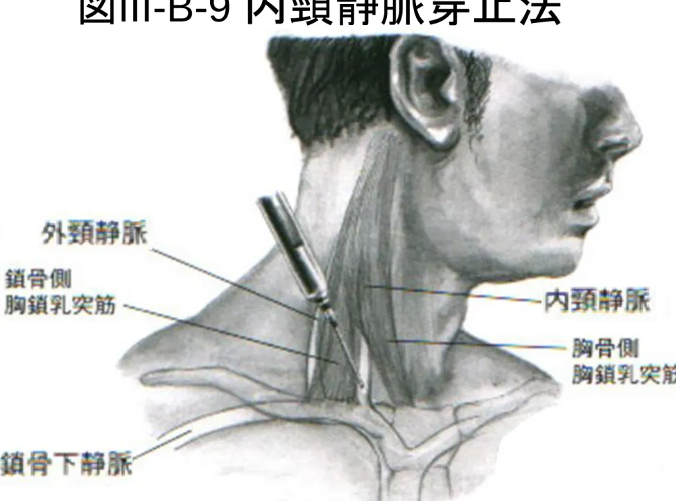 図 III-B-9  内頸静脈穿止法