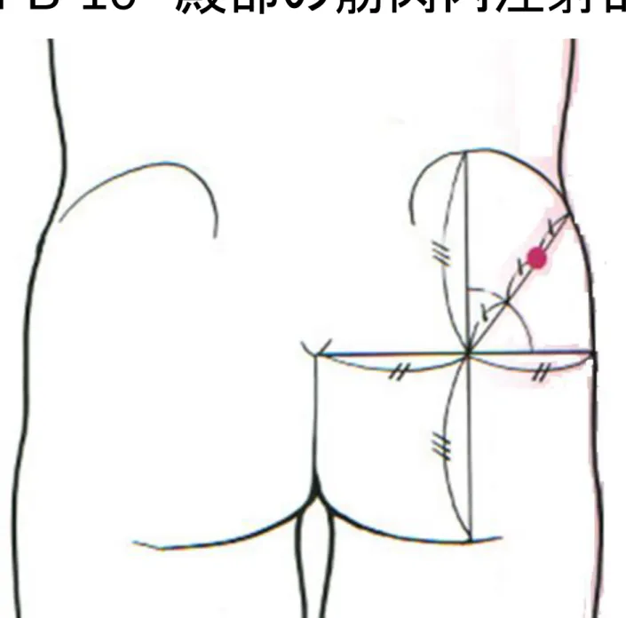 図 III-B-10   殿部の筋肉内注射部位