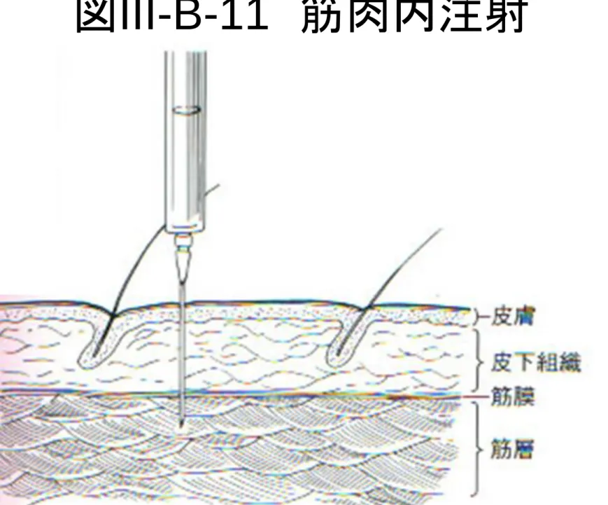 図 III-B-11   筋肉内注射