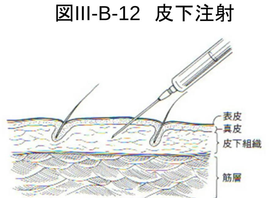 図 III-B-12   皮下注射