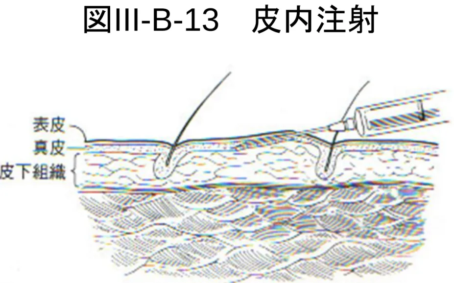 図 III-B-13    皮内注射