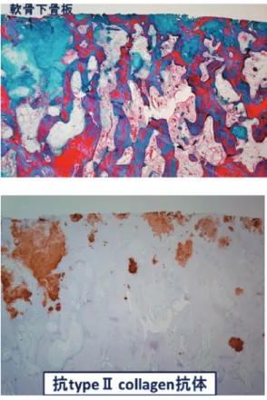 図 3. MRI で見られる bone marrow lesion  （BML）（骨 髄病変）の有無．