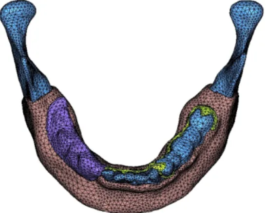Fig. 4 3d finite element model of denture    Fig. 5 Mandibular - mucosa - denture 3d  finite element model 3d 