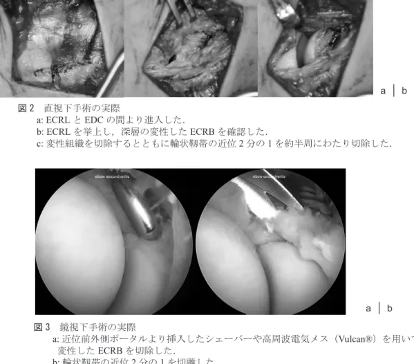 図 2　直視下手術の実際