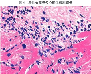 図 5　 EB ウ イ ル ス 小 分 子 RNA-1（EBV-encoded small RNA- RNA-1）を標的とした in situ hybridization