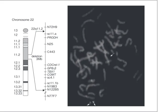Fig. 3　Typical deletion of del22q11.2 syndrome.22q11.2deletion3Mb13Chromosome 221211.211.111.111.212.112.212.313.113.213.3113.3213.33N72H9sc11.aN25C443βsc4.1sc11.1bN19B3N122B5N77F7