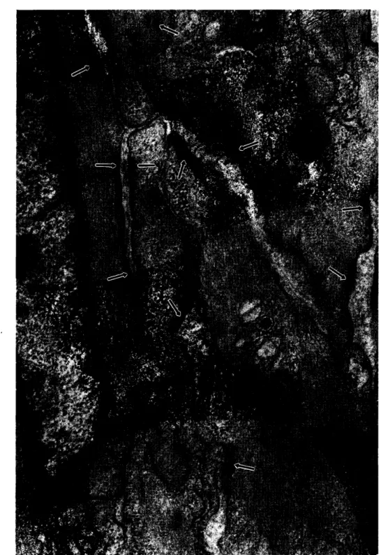 図 5 図 3 と同 じ箇所 の中膜 内層 の平滑筋細胞.平滑筋細胞 は極度 に収縮 し,互 いに s l i di ng し て密接す る. de ns ebody ( f us i f or m de ns i t y) や at t ac hme ntpl aque が著明であ る ( 矢 印)