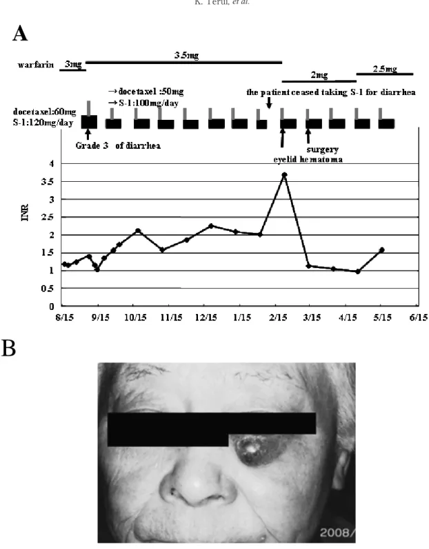Figure  1  （A） Changes  in  INR  during  concomitant  therapy  with  warfarin  and  S-1  in  case  1. （B） Subcutaneous  hematoma on the left lower eyelid in case 1.
