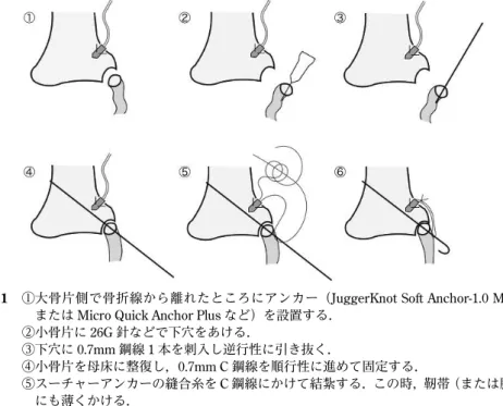 図 1  ① 大骨片側で骨折線から離れたところにアンカー（JuggerKnot Soft Anchor-1.0 Mini または Micro Quick Anchor Plus など）を設置する．