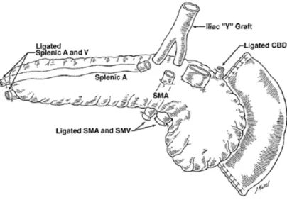 Figure 1. Schematic diagram of reconstruction of pancreas arterial supply, utilizing  Y graft of donor iliac vessel