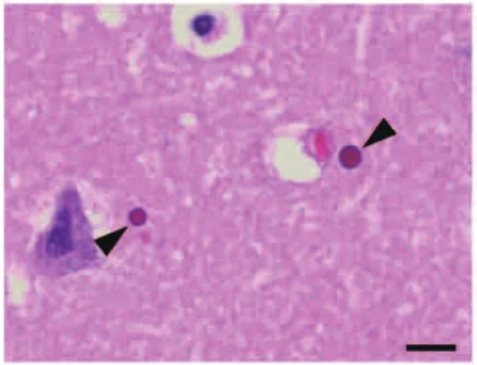 Figure 1 Light micrograph of microscopic globular bodies （arrowheads） in the  hippocampus, stained with HE