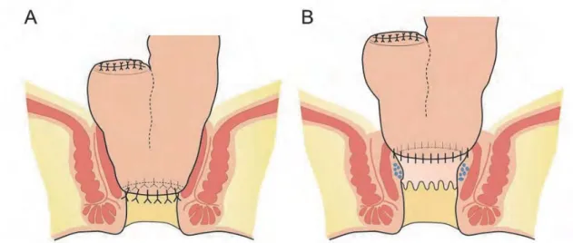 Figure  1 A:  The  ileal  pouch  anal  anastomosis （IPAA） operation  is  a  hand-sewn  method  and  anastomoses of the ileoanal pouch to the anus after removing the mucosa of the anal canal  more toward the oral side than the dentate line. B: The ileal pou