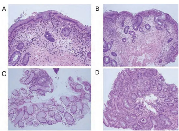 Figure 2 A: Crypt atrophy, there was an increased distance of more than one crypt diameter between crypts  and  a  general  increase  in  the  distance  between  the  crypts  and  the  muscular  mucosa.  B:  Crypt  distortion, there were two or more branch