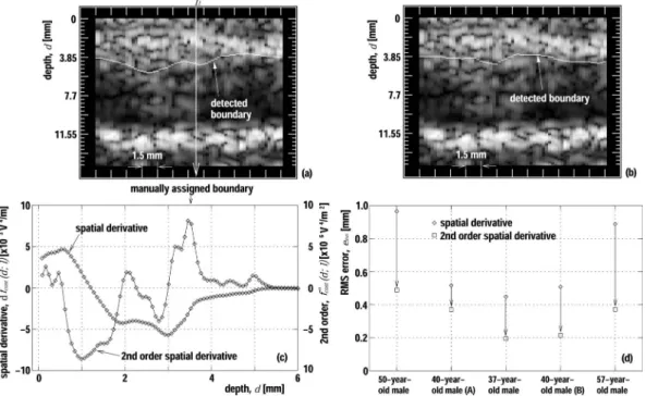 Fig. 15. Boundary detection of the anterior wall. (a) Detected boundary using the spatial derivative, df cost (d; ), of the cost function.