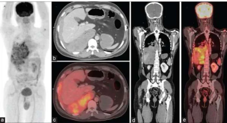 Figure 1.2: The example of an image from integrated SPECT-CT. This image is the transverse  and coronal images of a patient's SPECT-CT fused data sets including the three lower lumbar  vertebrae