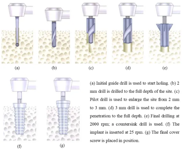 Fig. 1-9 Diagrams of surgical sequence using a bur and drill bits in dental implant placement [126] 