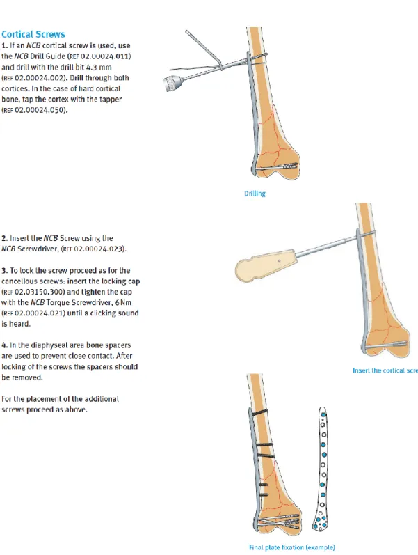 Fig. 1-11 Procedure manual of the insertion of cortical screws (Reprinted from [128]) 