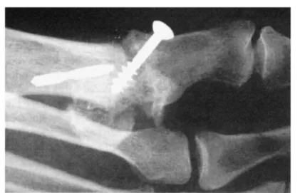 Fig. 1-12 An example of failure of drill bit left in situ [129] 