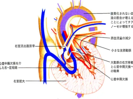 Fig. 1.2 Fallot 四徴症での血液循環（ [4] から改変）