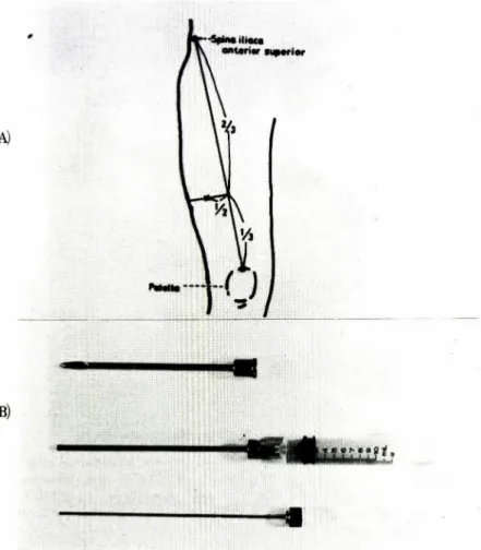 Fig  1.  A  biopsy  region(A)  and  the  modified  suctorial  needle  biopsy  device(B).