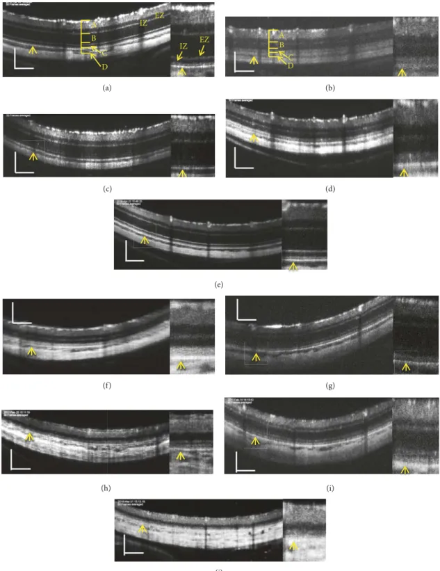 Figure 1: Representative pictures of spectral domain optical coherence tomography (SD-OCT) images of SD rats (a, c, e, g, and i) and S334ter rats (b, d, f, h, and j)