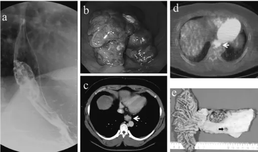 Fig. 1 （Case 1）　a : Barium esophagogram demonstrating a polypoid tumor in the lower tho-